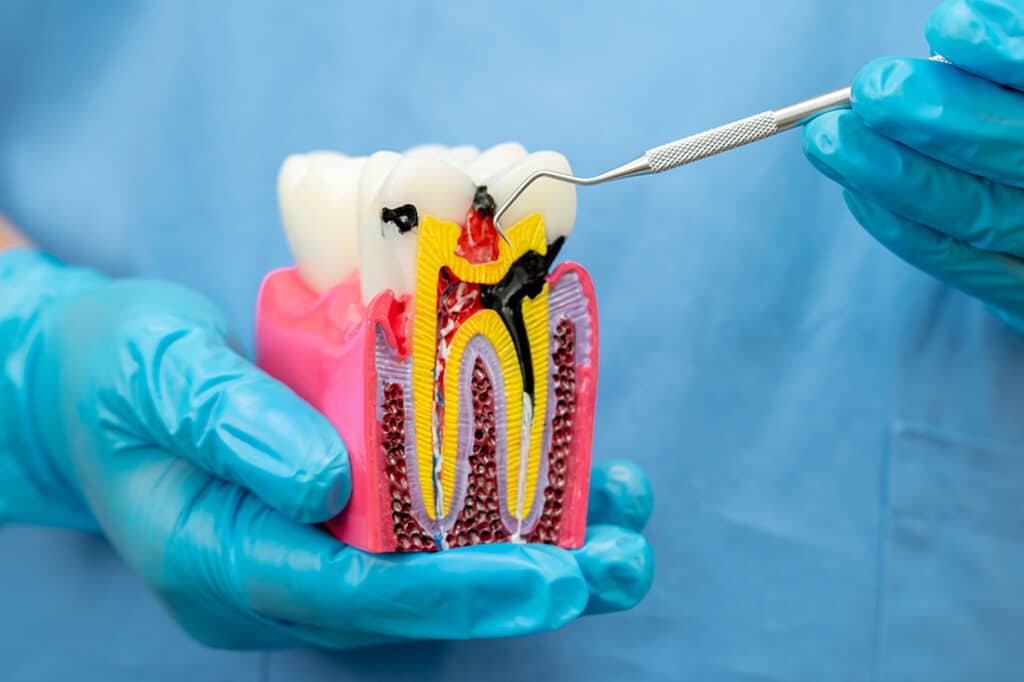 Dentist use dental instrument to check artificial tooth roots dental implant into jaw, Root canal model.